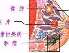 青春期乳房一抓捏里面有硬块可能是正常乳腺发育也需警惕纤维腺瘤及时就医