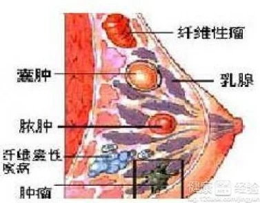 青春期乳房一抓捏里面有硬块可能是正常乳腺发育也需警惕纤维腺瘤及时就医